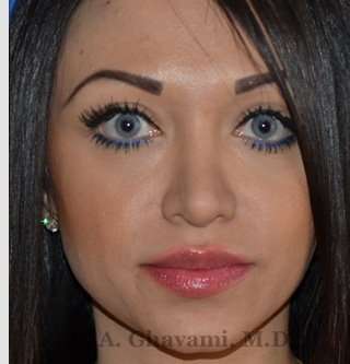 Revision Rhinoplasty Before & After Patient #7118