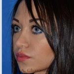 Revision Rhinoplasty Before & After Patient #7118