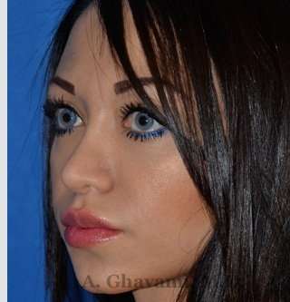 Revision Rhinoplasty Before & After Patient #7118