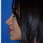 Revision Rhinoplasty Before & After Patient #7118