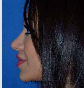 Revision Rhinoplasty Before & After Patient #7118