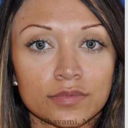 Revision Rhinoplasty Before & After Patient #7118