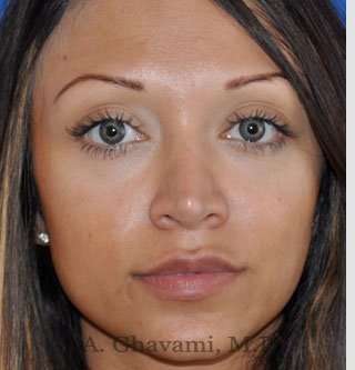 Revision Rhinoplasty Before & After Patient #7118