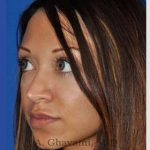 Revision Rhinoplasty Before & After Patient #7118
