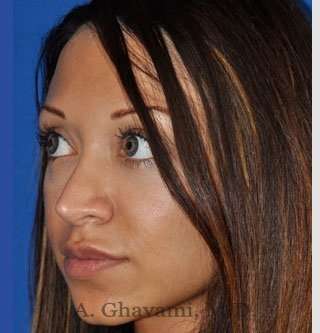 Revision Rhinoplasty Before & After Patient #7118