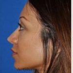 Revision Rhinoplasty Before & After Patient #7118