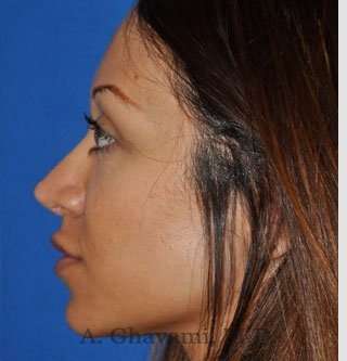 Revision Rhinoplasty Before & After Patient #7118