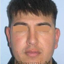 Male Rhinoplasty Before & After Patient #7077