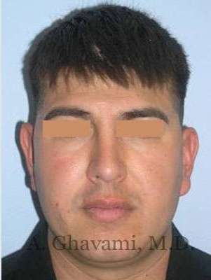 Male Rhinoplasty Before & After Patient #7077