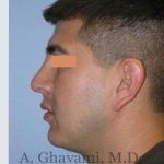 Male Rhinoplasty Before & After Patient #7077