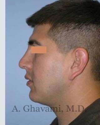 Male Rhinoplasty Before & After Patient #7077