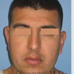 Male Rhinoplasty Before & After Patient #7077