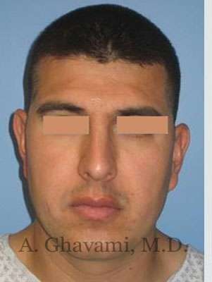 Male Rhinoplasty Before & After Patient #7077
