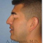Male Rhinoplasty Before & After Patient #7077