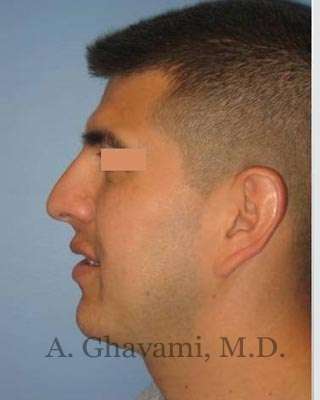 Male Rhinoplasty Before & After Patient #7077