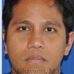 Male Rhinoplasty Before & After Patient #7072