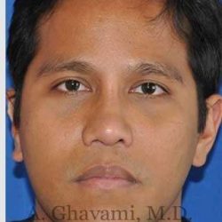 Male Rhinoplasty Before & After Patient #7072