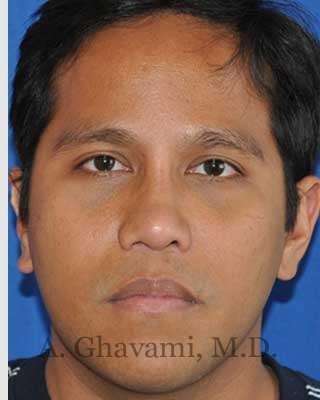 Male Rhinoplasty Before & After Patient #7072