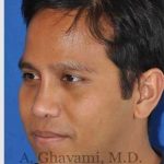Male Rhinoplasty Before & After Patient #7072