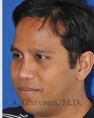 Male Rhinoplasty Before & After Patient #7072