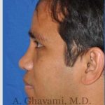 Male Rhinoplasty Before & After Patient #7072