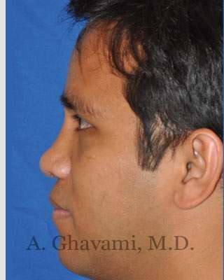 Male Rhinoplasty Before & After Patient #7072