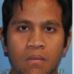 Male Rhinoplasty Before & After Patient #7072