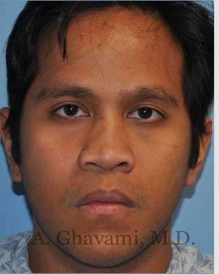 Male Rhinoplasty Before & After Patient #7072
