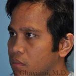 Male Rhinoplasty Before & After Patient #7072