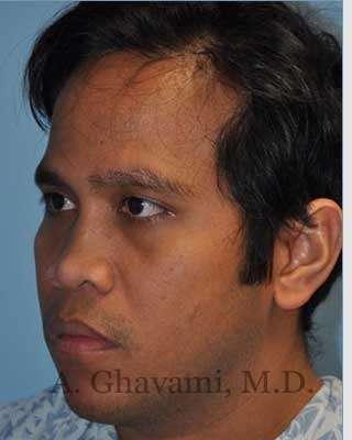 Male Rhinoplasty Before & After Patient #7072