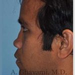 Male Rhinoplasty Before & After Patient #7072