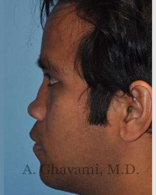 Male Rhinoplasty Before & After Patient #7072