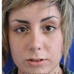 Rhinoplasty Before & After Patient #7040