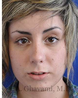 Rhinoplasty Before & After Patient #7040