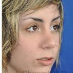 Rhinoplasty Before & After Patient #7040