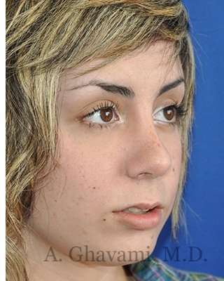 Rhinoplasty Before & After Patient #7040