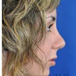 Rhinoplasty Before & After Patient #7040