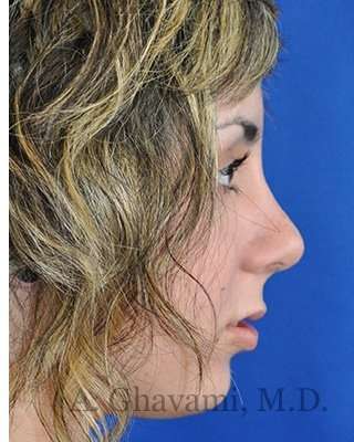 Rhinoplasty Before & After Patient #7040