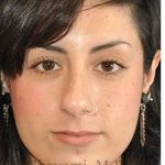 Rhinoplasty Before & After Patient #7040