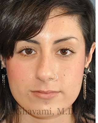 Rhinoplasty Before & After Patient #7040