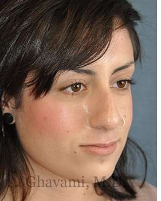 Rhinoplasty Before & After Patient #7040