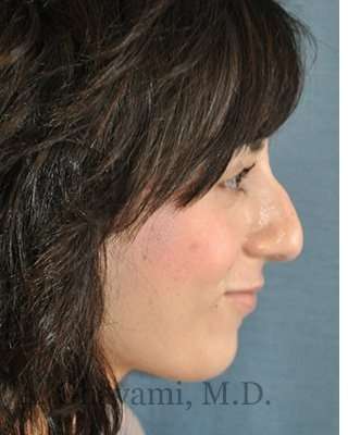 Rhinoplasty Before & After Patient #7040
