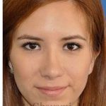 Revision Rhinoplasty Before & After Patient #7033