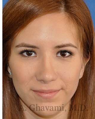 Revision Rhinoplasty Before & After Patient #7033