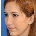 Revision Rhinoplasty Before & After Patient #7033