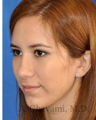 Revision Rhinoplasty Before & After Patient #7033