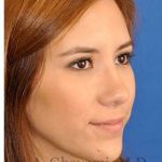 Revision Rhinoplasty Before & After Patient #7033