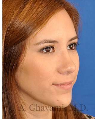 Revision Rhinoplasty Before & After Patient #7033