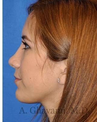 Revision Rhinoplasty Before & After Patient #7033