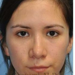 Revision Rhinoplasty Before & After Patient #7033